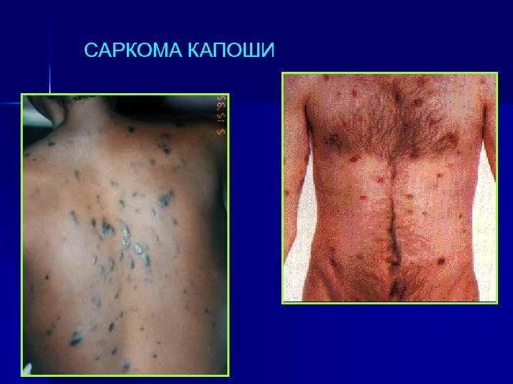 САРКОМА КАПОШИ 
