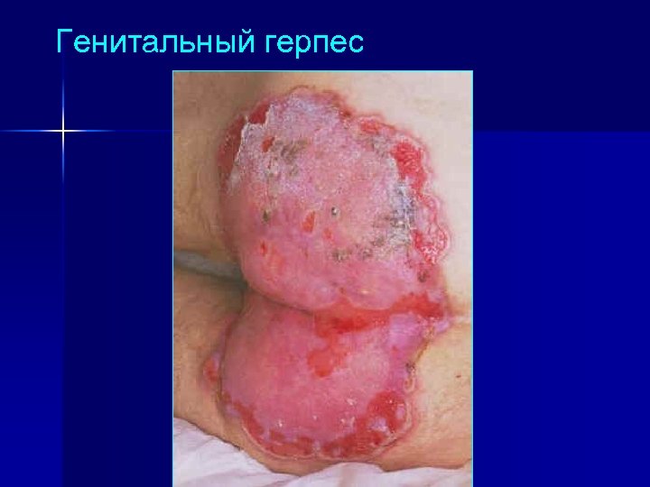 Генитальный герпес 