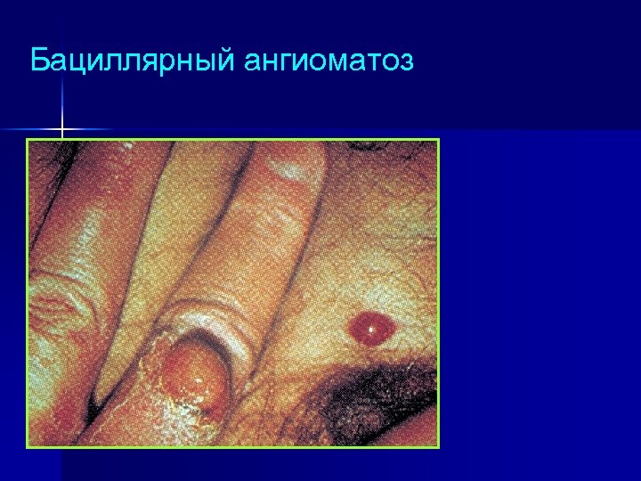 Бациллярный ангиоматоз 