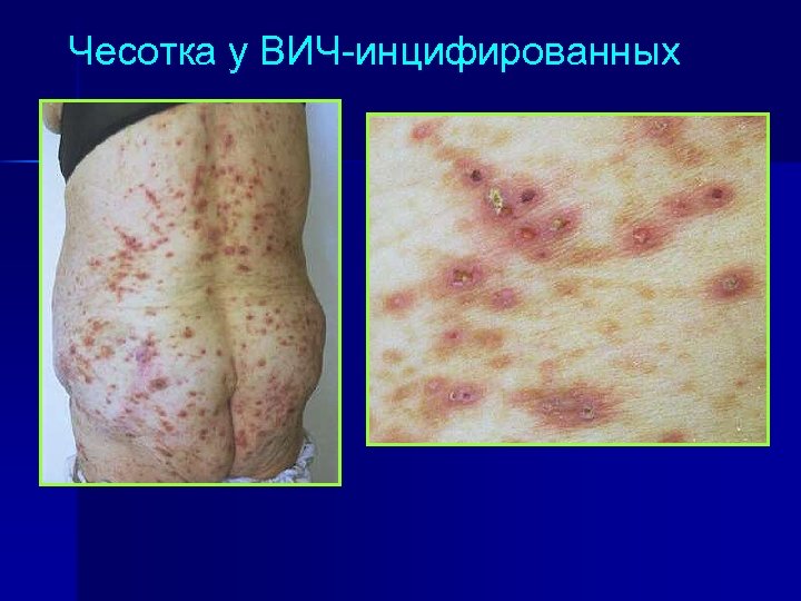 Чесотка у ВИЧ-инцифированных 