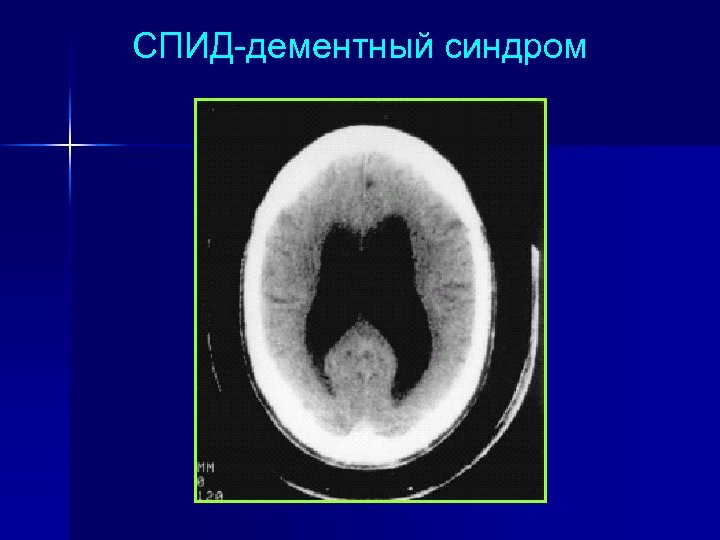 СПИД-дементный синдром 