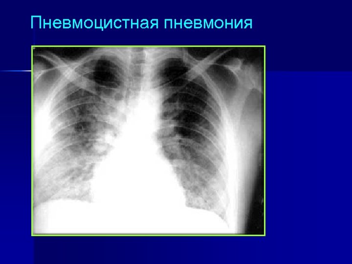 Пневмоцистная пневмония 