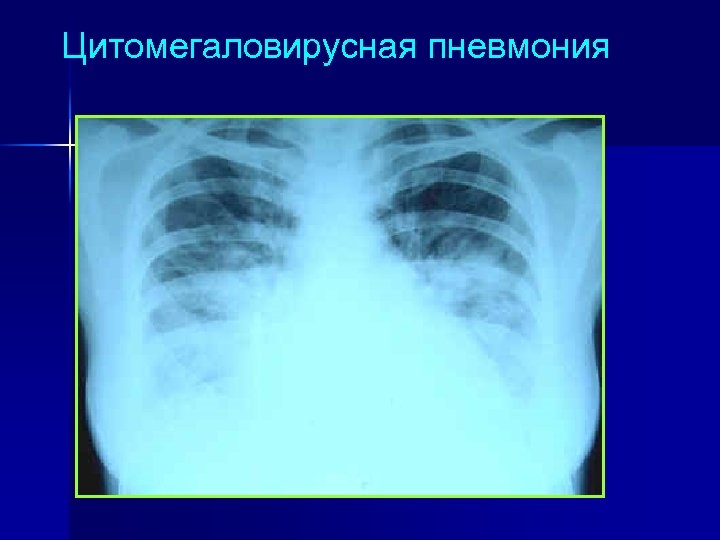 Цитомегаловирусная пневмония 