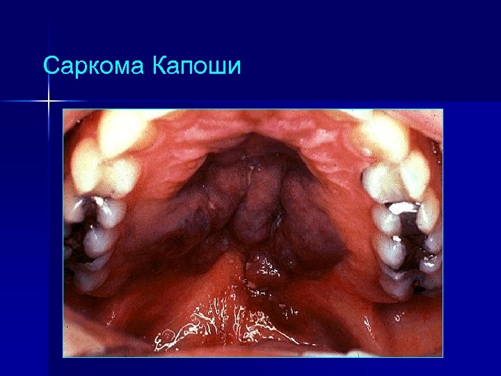 Саркома Капоши 