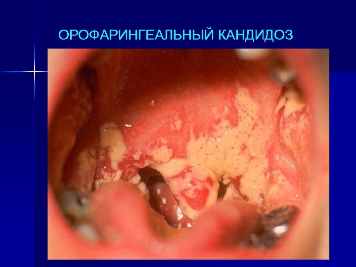 ОРОФАРИНГЕАЛЬНЫЙ КАНДИДОЗ 