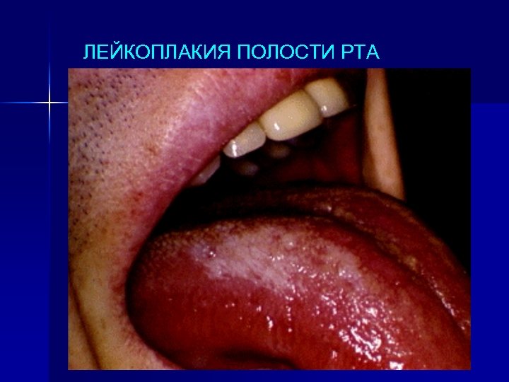 ЛЕЙКОПЛАКИЯ ПОЛОСТИ РТА 
