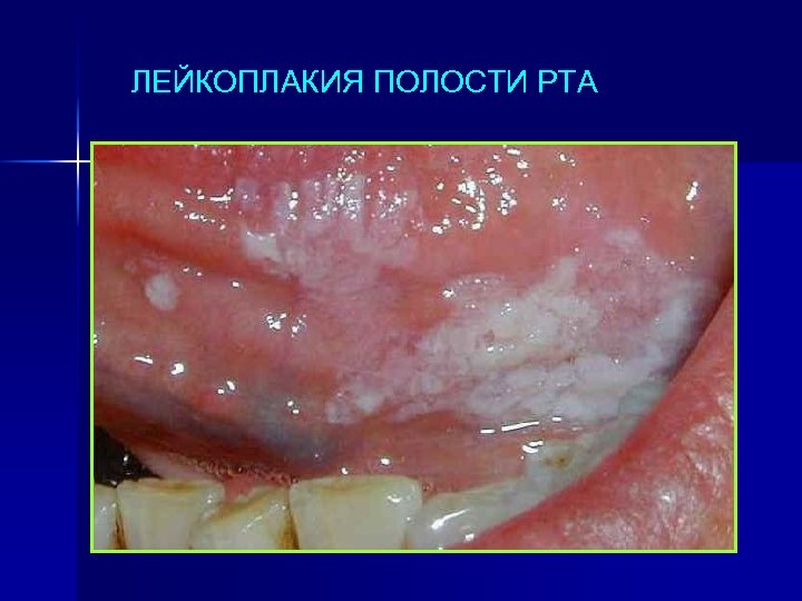 ЛЕЙКОПЛАКИЯ ПОЛОСТИ РТА 