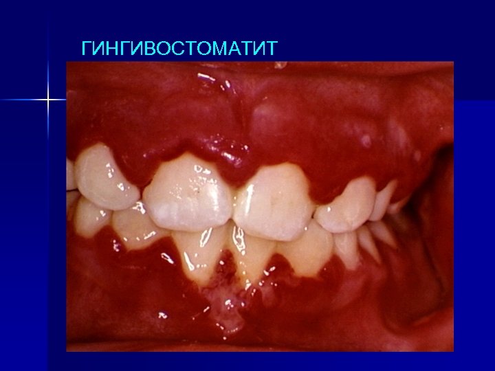 ГИНГИВОСТОМАТИТ 