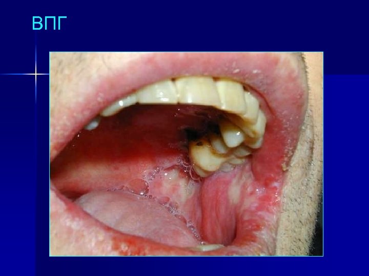 ВПГ 