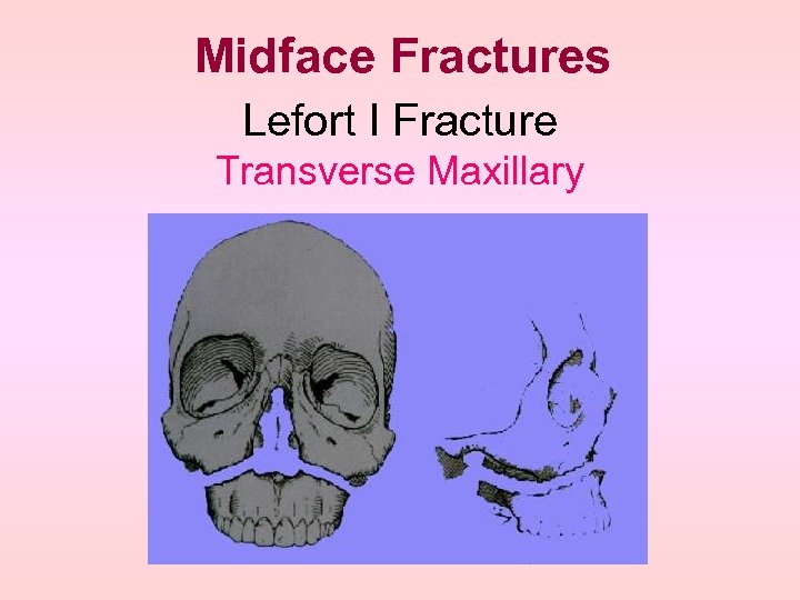 Midface Fractures Lefort I Fracture Transverse Maxillary 