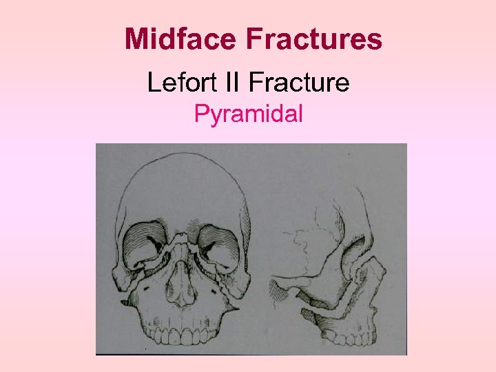 Midface Fractures Lefort II Fracture Pyramidal 