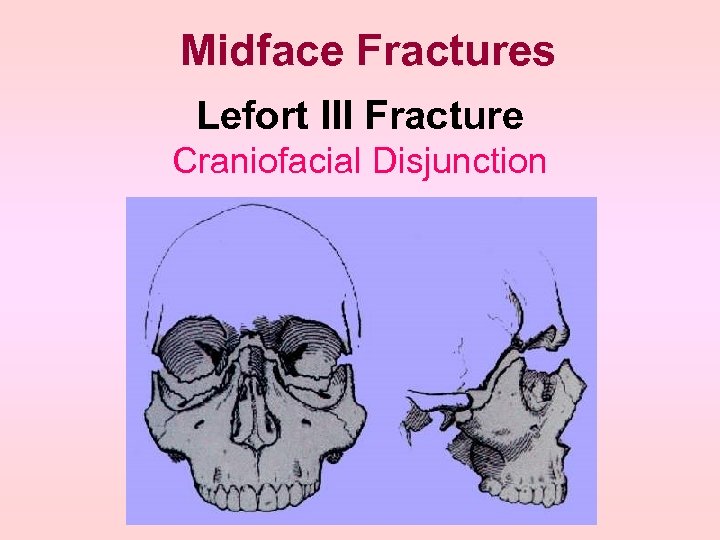 Midface Fractures Lefort III Fracture Craniofacial Disjunction 