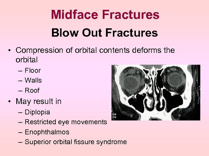 Midface Fractures Blow Out Fractures • Compression of orbital contents deforms the orbital –