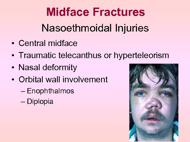 Midface Fractures Nasoethmoidal Injuries • • Central midface Traumatic telecanthus or hyperteleorism Nasal deformity