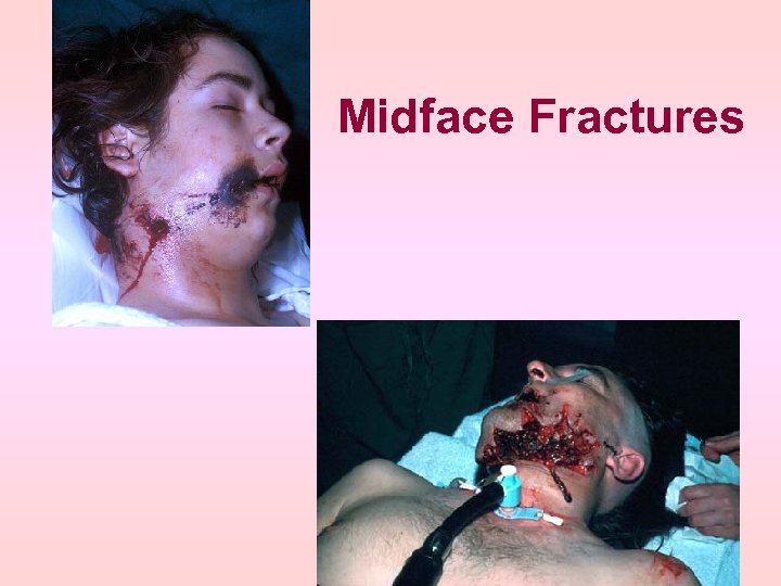 Midface Fractures 