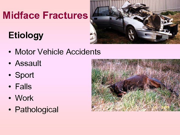 Midface Fractures Etiology • • • Motor Vehicle Accidents Assault Sport Falls Work Pathological