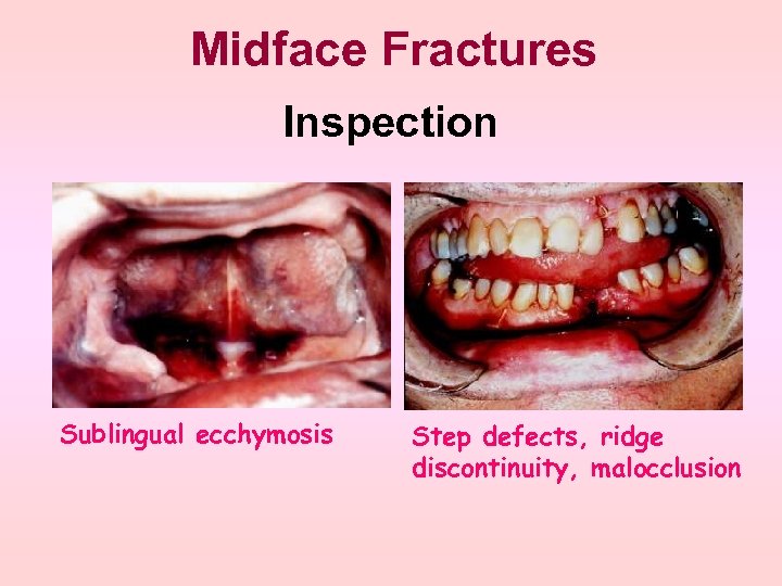 Midface Fractures Inspection Sublingual ecchymosis Step defects, ridge discontinuity, malocclusion 