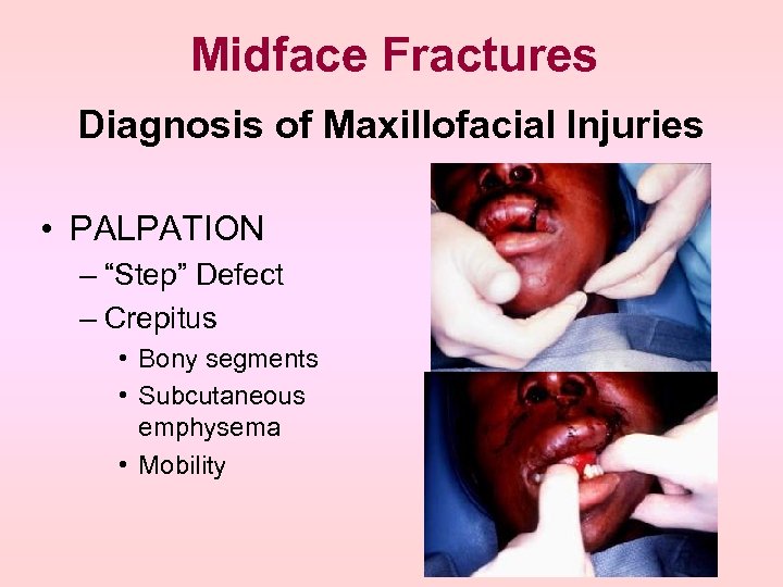 Midface Fractures Diagnosis of Maxillofacial Injuries • PALPATION – “Step” Defect – Crepitus •