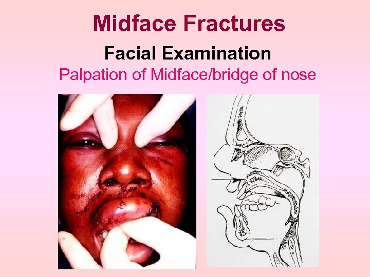 Midface Fractures Facial Examination Palpation of Midface/bridge of nose 