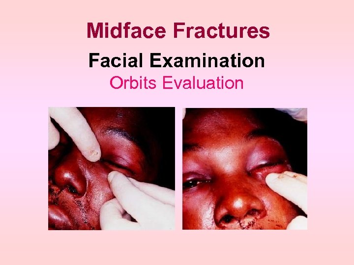 Midface Fractures Facial Examination Orbits Evaluation 