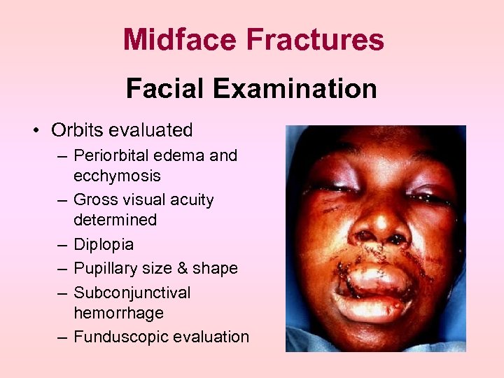Midface Fractures Facial Examination • Orbits evaluated – Periorbital edema and ecchymosis – Gross