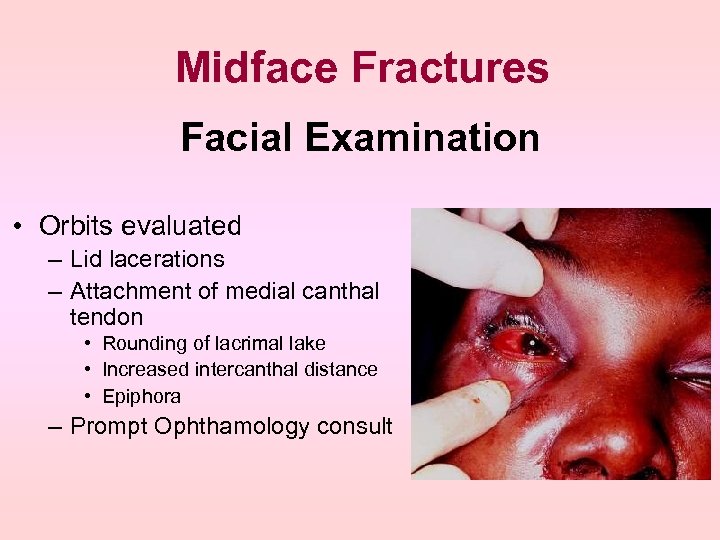 Midface Fractures Facial Examination • Orbits evaluated – Lid lacerations – Attachment of medial