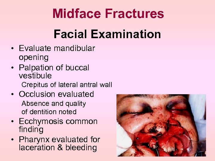 Midface Fractures Facial Examination • Evaluate mandibular opening • Palpation of buccal vestibule Crepitus