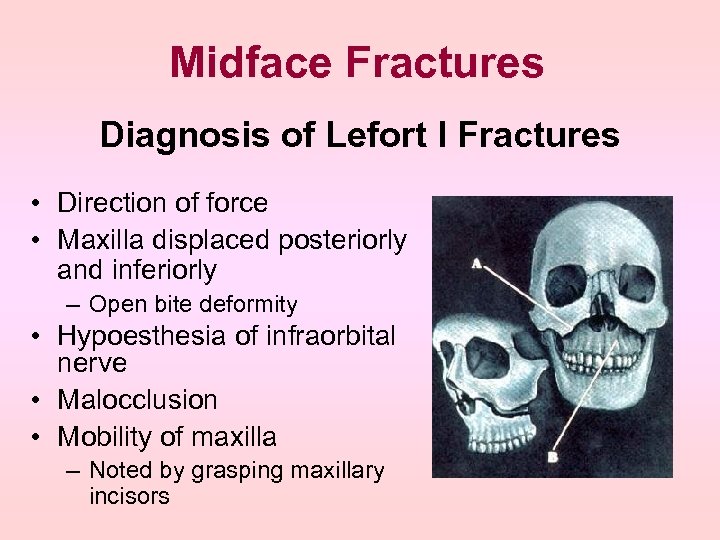 Midface Fractures Diagnosis of Lefort I Fractures • Direction of force • Maxilla displaced