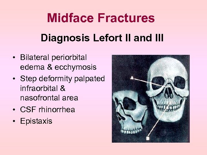 Midface Fractures Diagnosis Lefort II and III • Bilateral periorbital edema & ecchymosis •