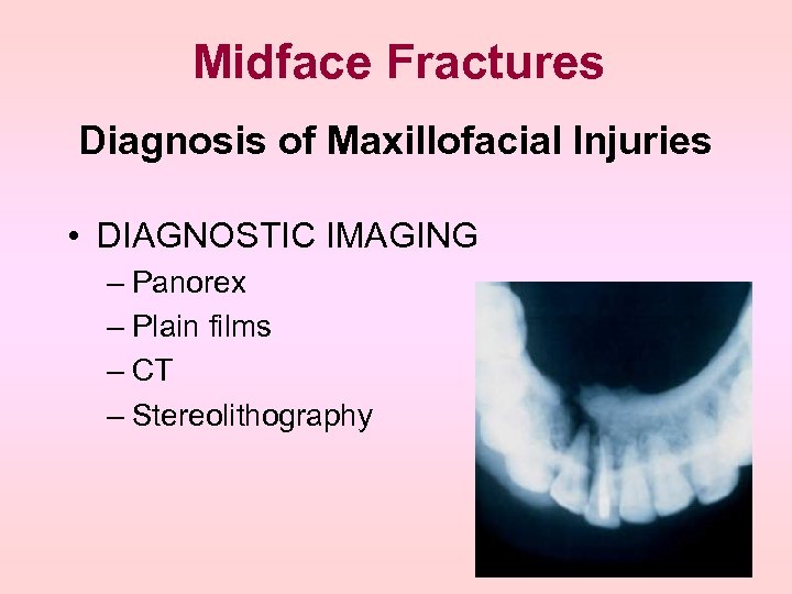 Midface Fractures Diagnosis of Maxillofacial Injuries • DIAGNOSTIC IMAGING – Panorex – Plain films