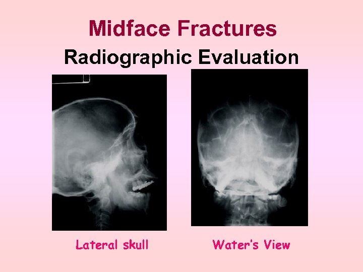 Midface Fractures Radiographic Evaluation Lateral skull Water’s View 