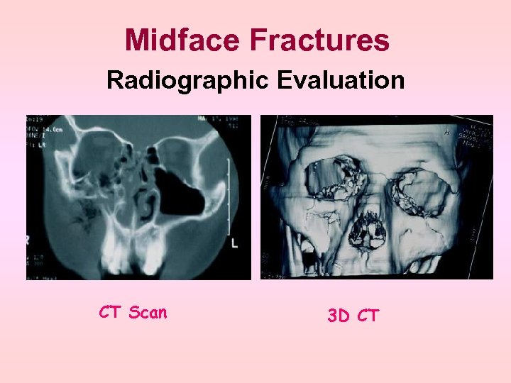 Midface Fractures Radiographic Evaluation CT Scan 3 D CT 