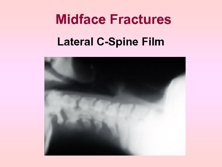 Midface Fractures Lateral C-Spine Film 