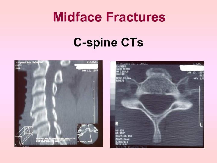 Midface Fractures C-spine CTs 