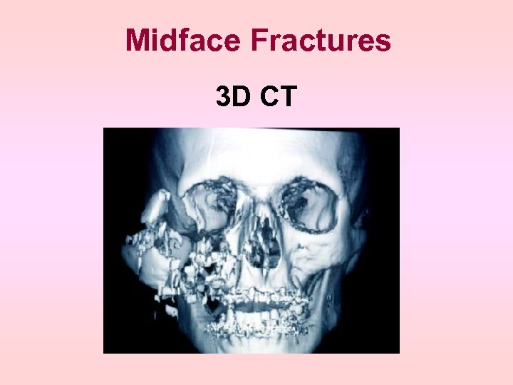 Midface Fractures 3 D CT 