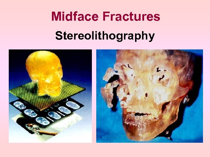 Midface Fractures Stereolithography 