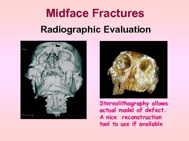 Midface Fractures Radiographic Evaluation Stereolithography allows actual model of defect. A nice reconstruction tool