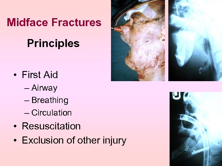 Midface Fractures Principles • First Aid – Airway – Breathing – Circulation • Resuscitation