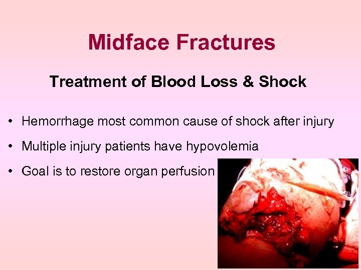 Midface Fractures Treatment of Blood Loss & Shock • Hemorrhage most common cause of
