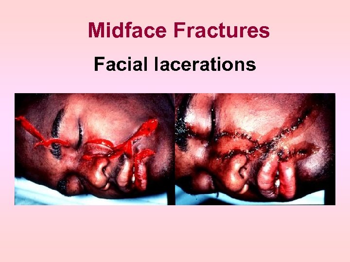 Midface Fractures Facial lacerations 