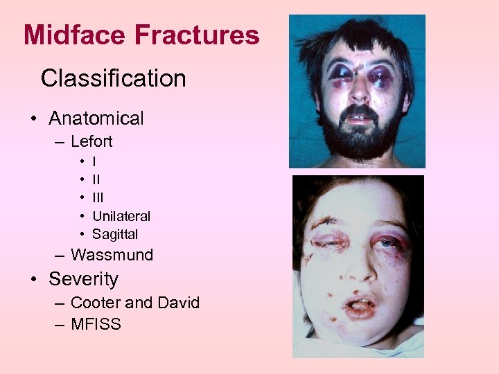 Midface Fractures Classification • Anatomical – Lefort • • • I II III Unilateral