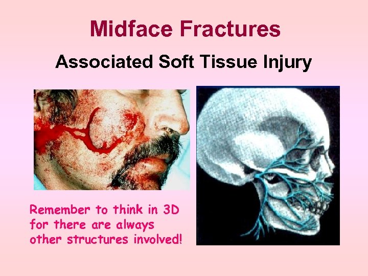 Midface Fractures Associated Soft Tissue Injury Remember to think in 3 D for there