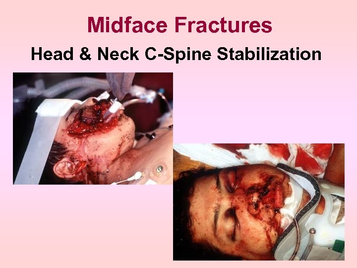 Midface Fractures Head & Neck C-Spine Stabilization 