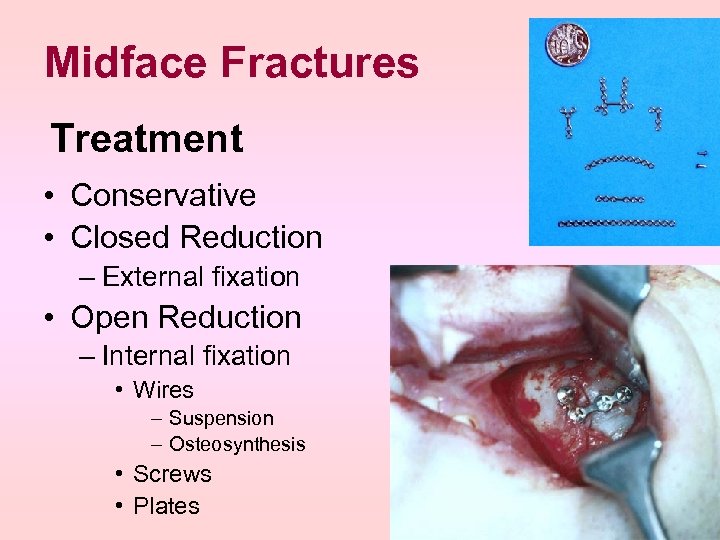 Midface Fractures Treatment • Conservative • Closed Reduction – External fixation • Open Reduction