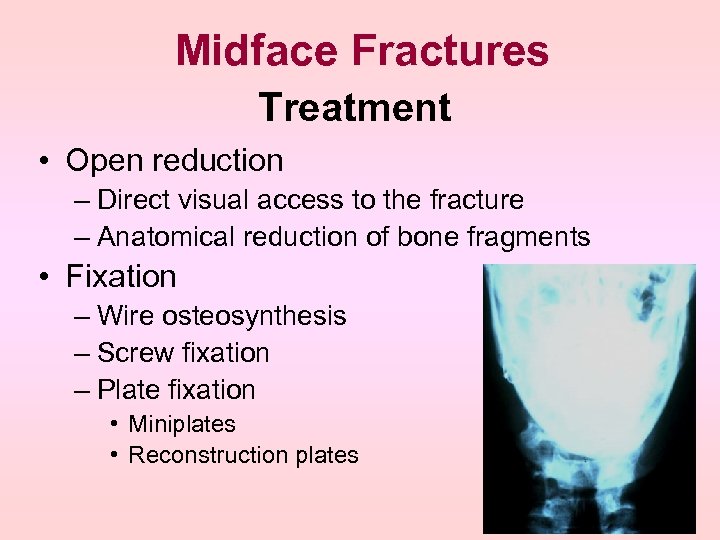 Midface Fractures Treatment • Open reduction – Direct visual access to the fracture –