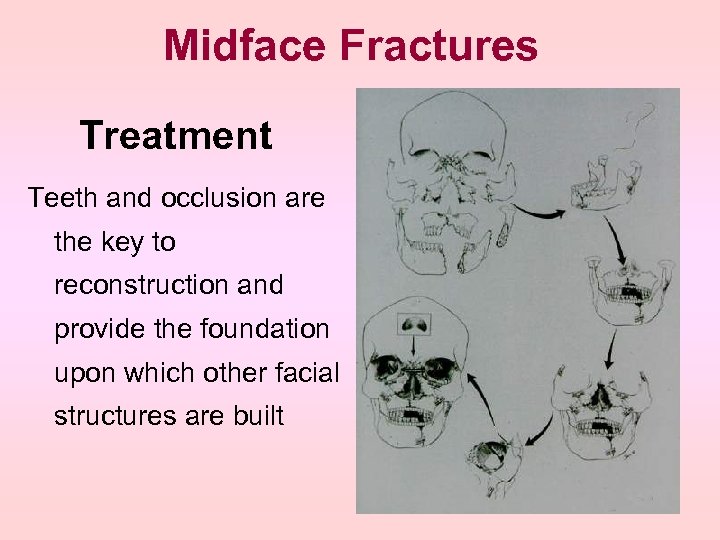 Midface Fractures Treatment Teeth and occlusion are the key to reconstruction and provide the