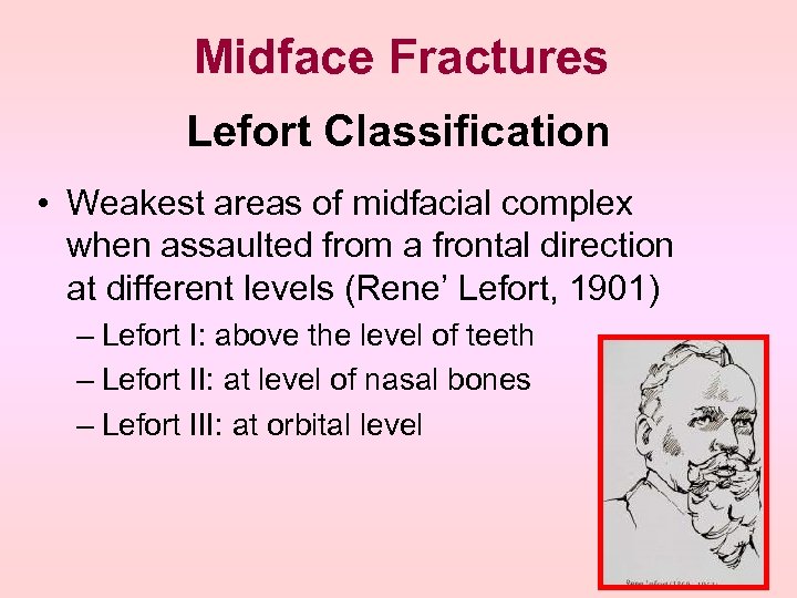 Midface Fractures Lefort Classification • Weakest areas of midfacial complex when assaulted from a