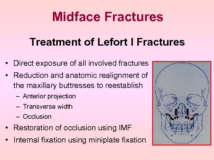 Midface Fractures Treatment of Lefort I Fractures • Direct exposure of all involved fractures