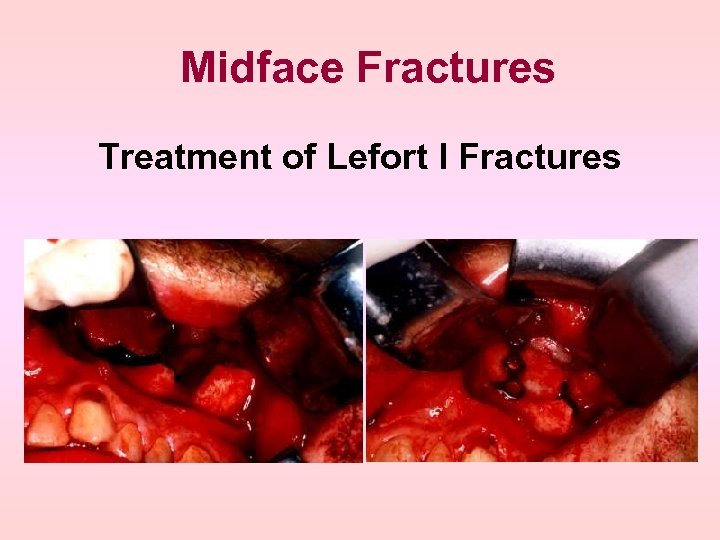 Midface Fractures Treatment of Lefort I Fractures 