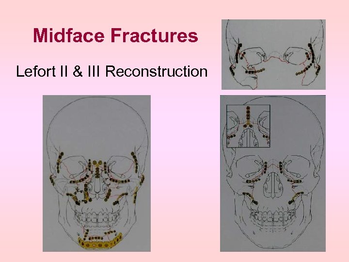 Midface Fractures Lefort II & III Reconstruction 